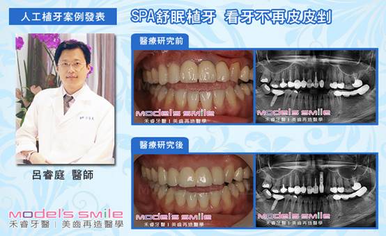 微創植牙 微創植牙