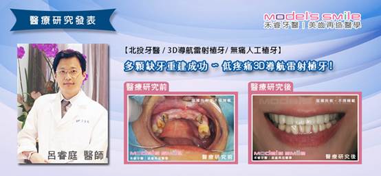 微創植牙 微創植牙